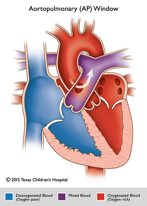 Aortopulmonary Window Pediatric Echocardiography